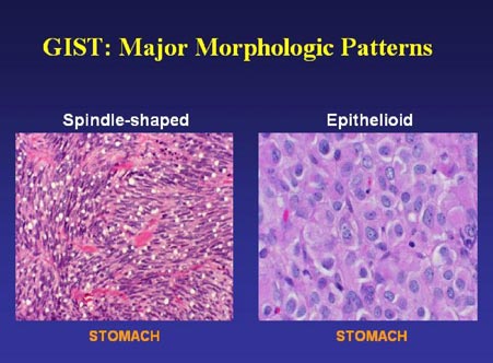 Common Spindle Cell Malignant Neoplasms of the ... - Internet