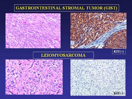 Tumor de gist esperanza de vida